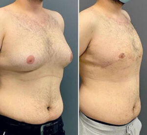 Causes of Gynecomastia